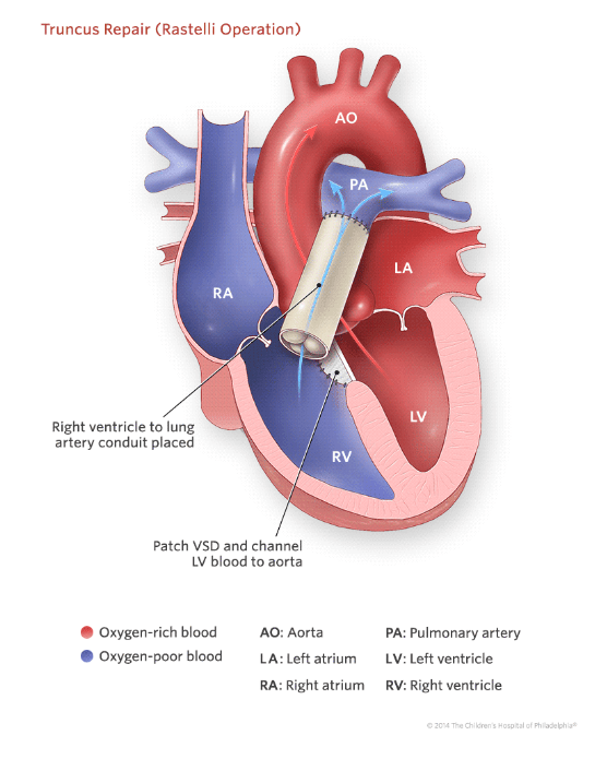 How is TA Repaired? Mending Katja’s heart Part&nbsp;1
